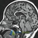 Neurocistocircose no Cérebro
